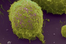 VIH à la surface d’un lymphocyte agrandi 7 000 fois. / © Virus sur lymphocyte : eye of science 